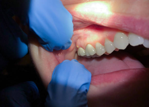 Best Broken or Chipped Tooth Repair in Nottingham, PA